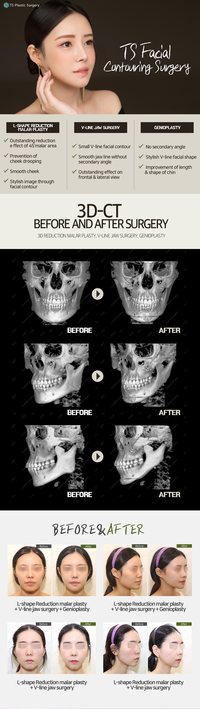 TS Plastic Surgery's facial contouring surgery