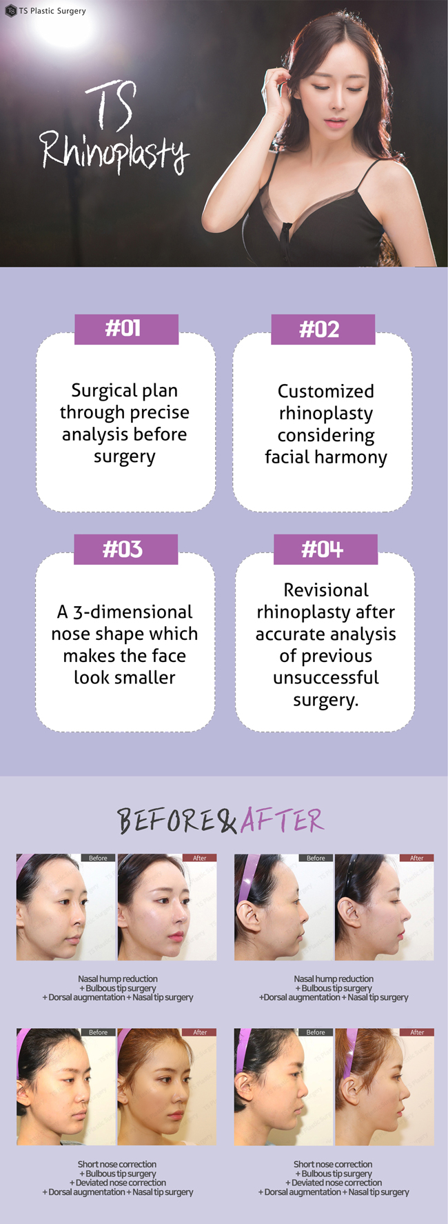 TS Plastic Surgery's rhinoplasty 