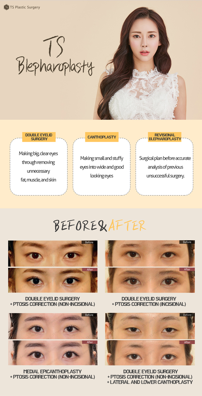 TS Plastic Surgery's blepharoplasty