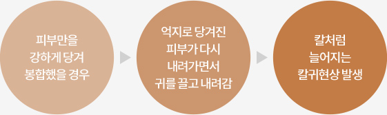 피부만을 강하게 당겨 봉합했을 경우 > 억지로 당겨진 > 피부가 다시 내려가면서 귀를 끌고 내려감 > 칼처럼 늘어지는 칼귀현상 발생
