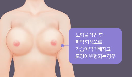 보형물 삽입 후 피막 형성으로 가슴이 딱딱해지고 모양이 변형되는 경우