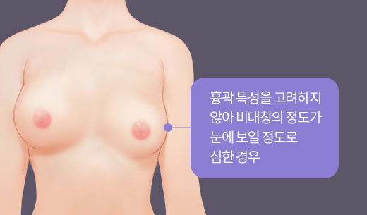 흉곽 특성을 고려하지 않아 비대칭의 정도가 눈에 보일 정도로 심한 경우