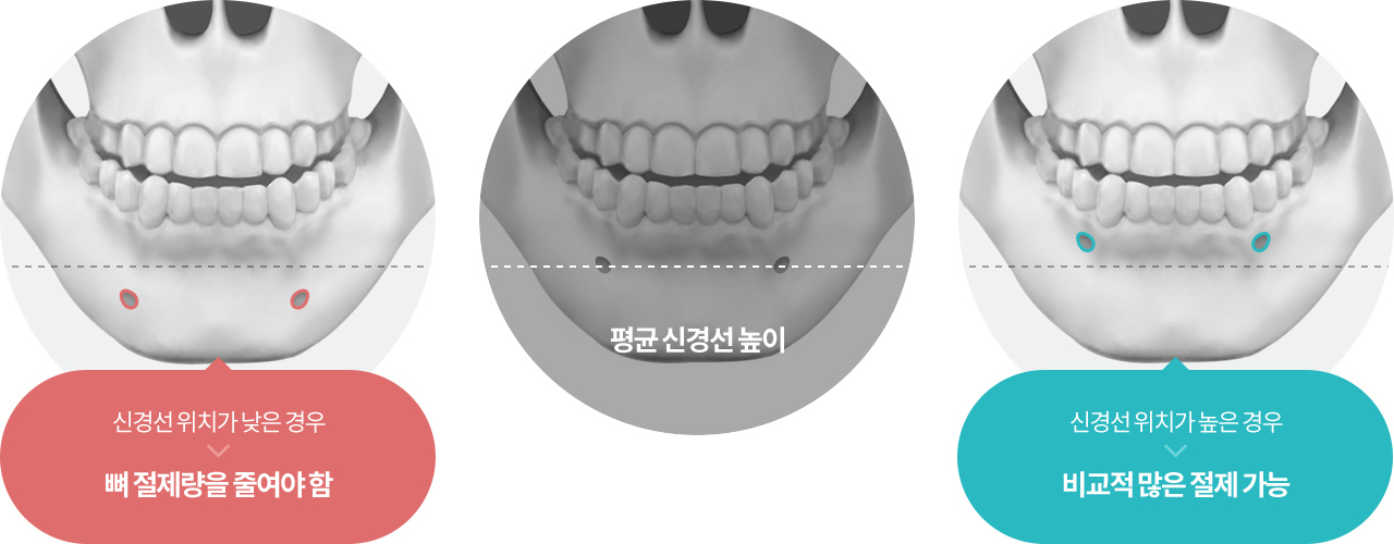 신경선 위치가 낮은 경우 신경선 위치가 낮은 경우 , 평균 신경선 높이 , 신경선 위치가 높은 경우 비교적 많은 절제 가능 