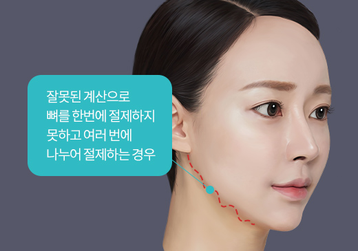 잘못된 계산으로 뼈를 한번에 절제하지 못하고 여러 번에 나누어 절제하는 경우