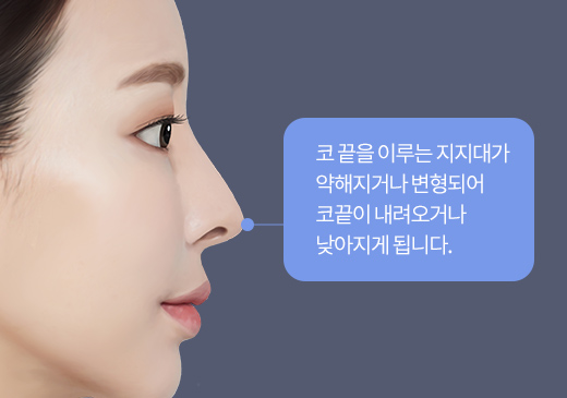 코 끝을 이루는 지지대가 약해지거나 변형되어 코끝이 내려오거나 낮아지게 됩니다.