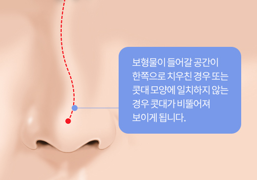 보형물이 들어갈 공간이 한쪽으로 치우친 경우 또는 콧대 모양에 일치하지 않는 경우 콧대가 비뚤어져 보이게 됩니다.