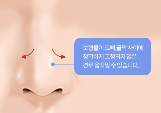 보형물이 코뼈,골막 사이에 정확하게 고정되지 않은 경우 움직일 수 있습니다.