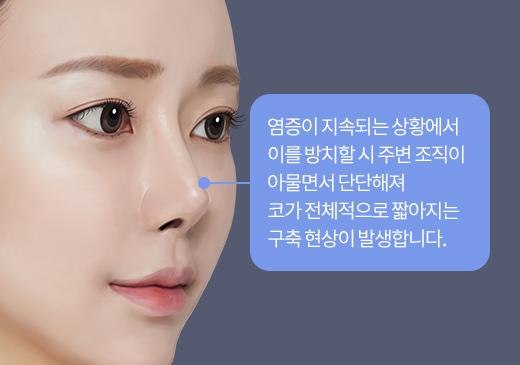 염증이 지속되는 상황에서  이를 방치할 시 주변 조직이 아물면서 단단해져  코가 전체적으로 짧아지는  구축 현상이 발생합니다.