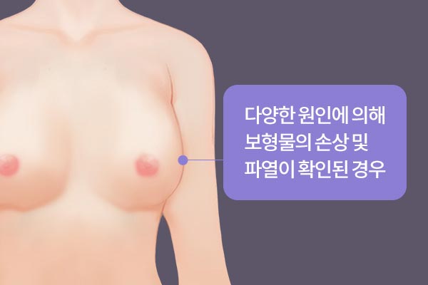다양한 원인에 의해 보형물의 손상 및 파열이 확인된 경우