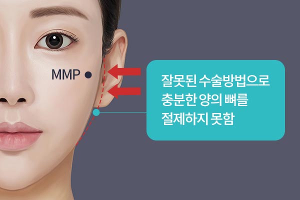 잘못된 수술방법으로 충분한 양의 뼈를 절제하지 못함