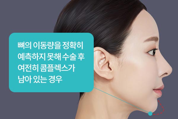 뼈의 이동량을 정확히 예측하지 못해 수술 후 여전히 콤플렉스가 남아 있는 경우