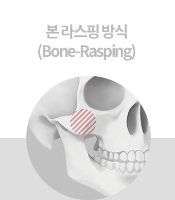 본 라스핑 방식(Bone-Rasping)