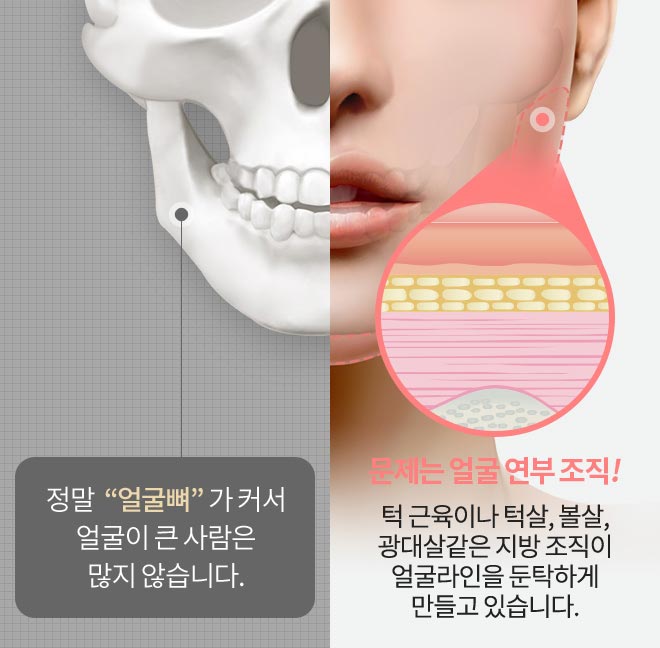 정말 “얼굴뼈” 가 커서 얼굴이 큰 사람은 많지 않습니다. 문제는 얼굴 연부 조직! 턱 근육이나 턱살, 볼살, 광대살같은 지방 조직이 얼굴라인을 둔탁하게 만들고 있습니다.